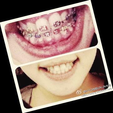 国产牙套测评图片高清视频